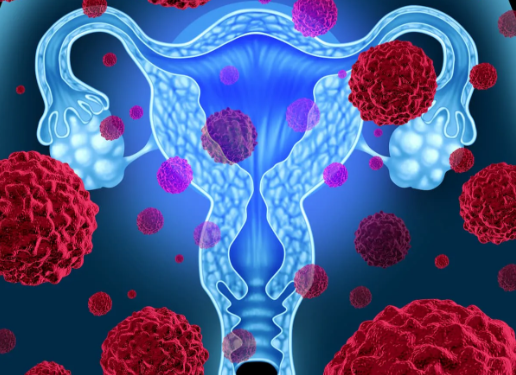 Study Finds Transvaginal Ultrasound Unreliable for Detecting Endometrial Cancer in Black Patients