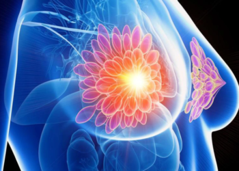 Image Source: Creative Commons License, Mammogram showing a cancerous lesion.