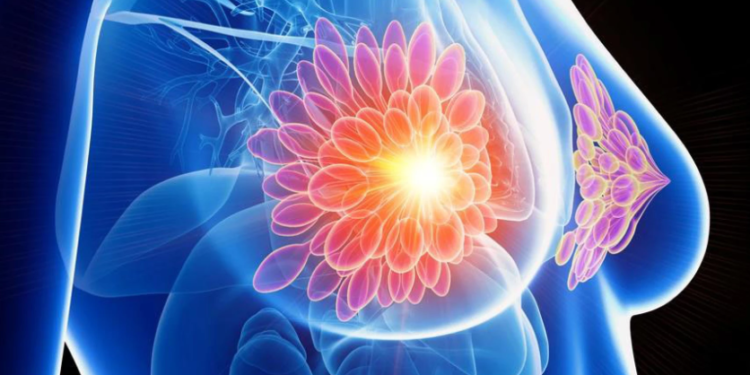 Image Source: Creative Commons License, Mammogram showing a cancerous lesion.