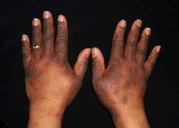 Atopic Dermatitis In A Pizza Shop Worker.image From Matt Zirwas