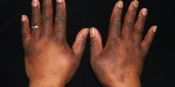 Atopic Dermatitis In A Pizza Shop Worker.image From Matt Zirwas