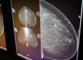 A mammogram is an X-ray image of the breast used for cancer screening. (CBC News)