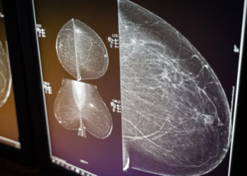 A mammogram is an X-ray image of the breast used for cancer screening. (CBC News)