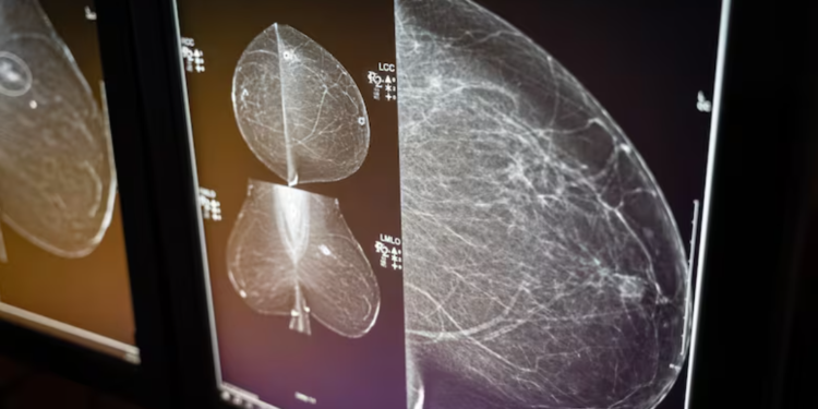 A mammogram is an X-ray image of the breast used for cancer screening. (CBC News)
