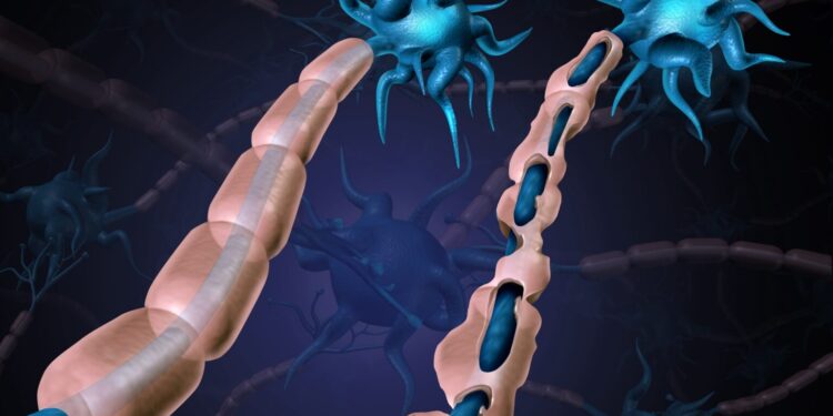 Multiple Sclerosis Damaged Myelin