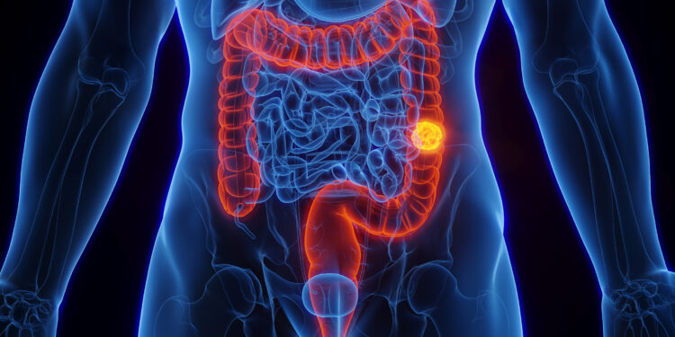 Rep. Watson Coleman introduces resolution calling for increased research in colorectal cancer