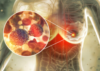 Black patients with metastatic breast cancer experience higher mortality rates than white patients