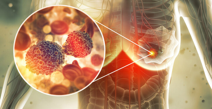 Black patients with metastatic breast cancer experience higher mortality rates than white patients
