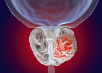 Understanding prostate cancer trials for Black men