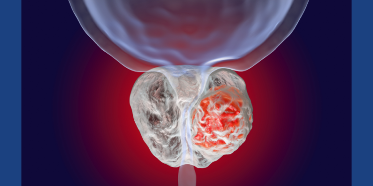 Understanding prostate cancer trials for Black men