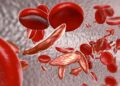 Sickle cell trait linked to elevated acute heart failure in Black Americans