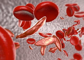 Sickle cell trait linked to elevated acute heart failure in Black Americans