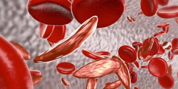 Sickle cell trait linked to elevated acute heart failure in Black Americans