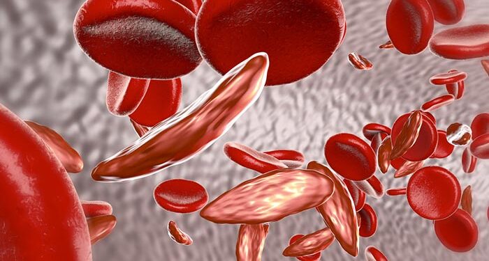 Sickle cell trait linked to elevated acute heart failure in Black Americans