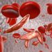 Sickle cell trait linked to elevated acute heart failure in Black Americans