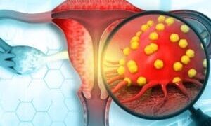 Uterine cancer rates predicted to rise, especially among Black women