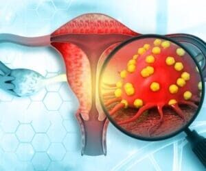 Uterine cancer rates predicted to rise, especially among Black women